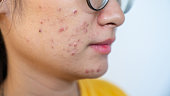 Close up of worried Asian woman having acne inflamed on her face.