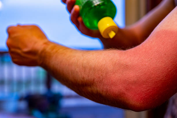 istock applying aloe vera gel to a red sunburn on an arm 1458004255