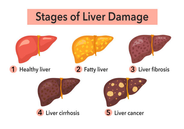 Stages of liver damage infographic concept vector illustration. Fatty liver, cirrhosis and liver cancer in flat design on white background. vector art illustration