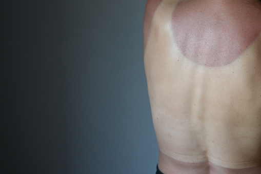 Close up of young naked woman with sunburn marks on the body, studio gray background.
