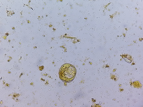 Microscopic examination of Stool showing Blastocystis hominis parasite.