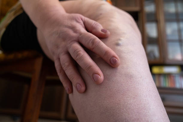 Mature woman massaging her leg with varicose veins. Mature woman sits on a chair and rubs her leg with varicose veins. obese joint pain stock pictures, royalty-free photos & images