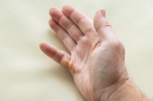 Dupuytren's contracture on right hand little finger of 53 year old man's palm.