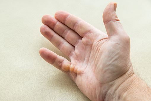 Dupuytren's contracture on right hand little finger of 53 year old man's palm.