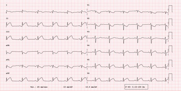 ECG example of 12-lead rhythm, acute myocardial infarction vector art illustration