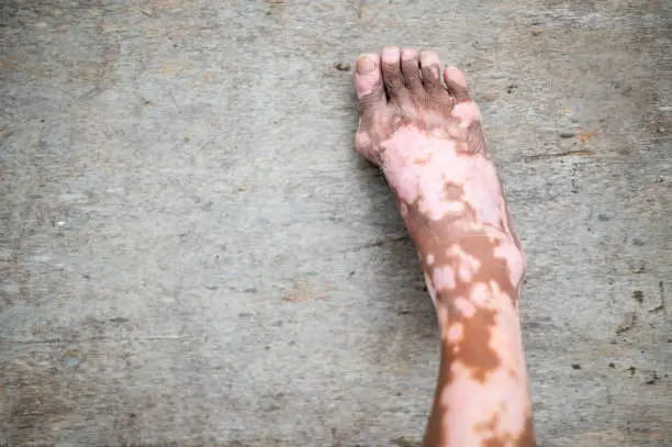 Photo of The old mans leg with skin condition that causes loss of melanin posing indoors. The foot model in black tank top suffering from vitiligo disorder.