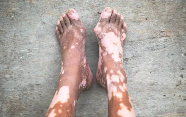 Photo of The old mans leg with skin condition that causes loss of melanin posing indoors. The foot model in black tank top suffering from vitiligo disorder.