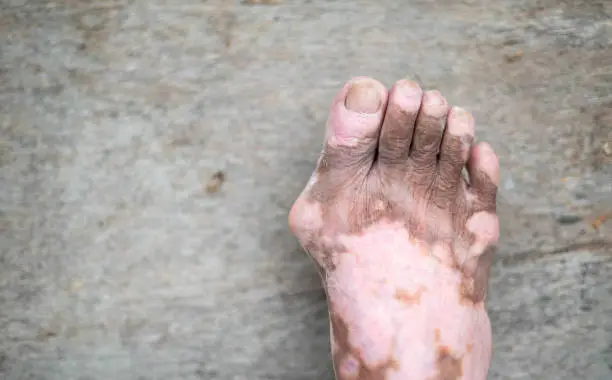 Photo of The old mans leg with skin condition that causes loss of melanin posing indoors. The foot and finger model in black tank top suffering from vitiligo disorder.