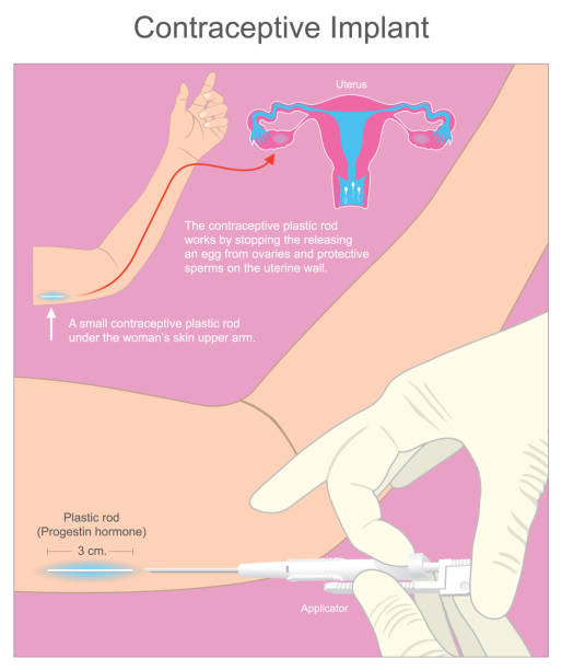 contraceptive implant. a small contraceptive plastic rod under the womans skin upper arm. - 家庭計劃 幅插畫檔、美工圖案、卡通及圖標