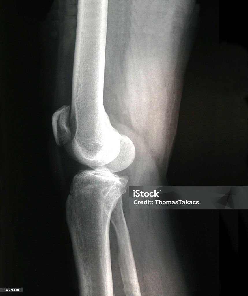 X-Ray  Male Right Knee - Side X-ray of middle-aged male right knee as viewed from the side. Arthritis Stock Photo