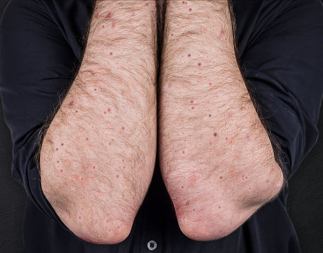 Measles. Viral disease of immunodeficiency dermatitis rash on the body of a man, scratch with itching, viral exanthema. A patient with monkeypox. Painful rash, red spots, blisters on the arm.