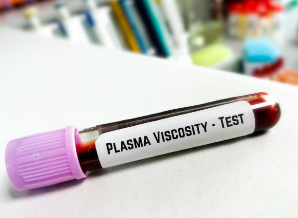 blood sample for plasma viscosity test, diagnosis for polymyalgia rheumatica, giant cell arteritis or temporal arteritis, such as headaches, neck or shoulder pain, pelvic pain, joint stiffness. - blood red blood cell blood cell blood sample imagens e fotografias de stock