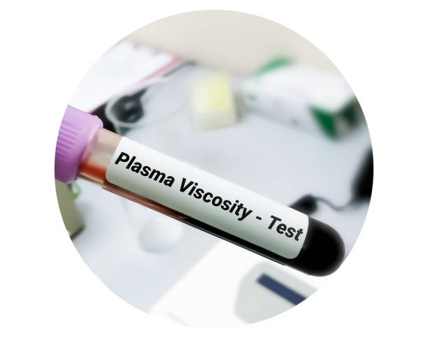 blood sample for plasma viscosity test, diagnosis for polymyalgia rheumatica, giant cell arteritis or temporal arteritis, such as headaches, neck or shoulder pain, pelvic pain, joint stiffness. - blood red blood cell blood cell blood sample imagens e fotografias de stock