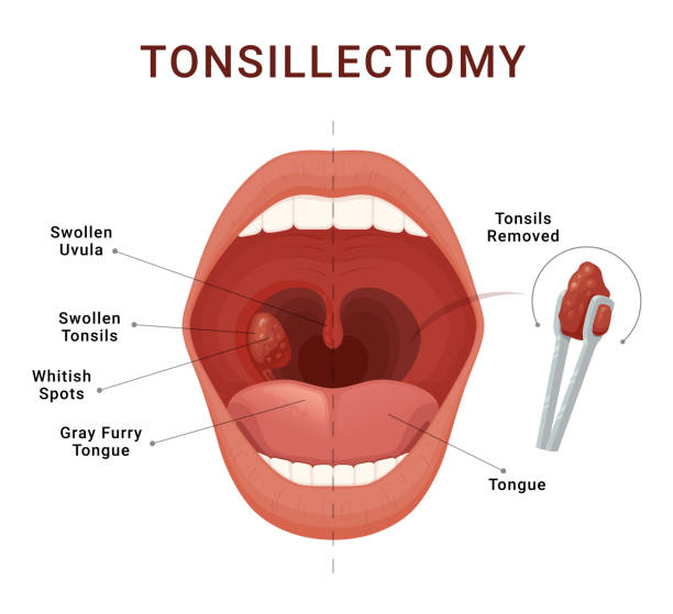 bildbanksillustrationer, clip art samt tecknat material och ikoner med tonsillectomy scheme removal of palatine tonsils acute pharyngitis vector isometric illustration - tonsill
