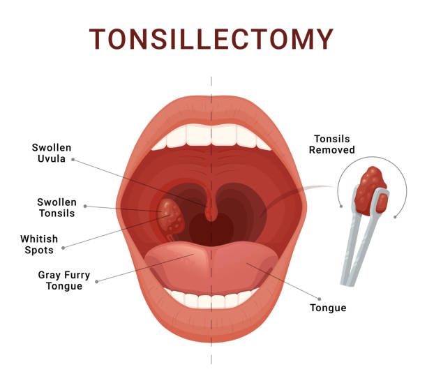 Tonsillectomy scheme removal of palatine tonsils acute pharyngitis vector isometric illustration Tonsillectomy scheme removal of palatine tonsils acute pharyngitis vector isometric illustration. Open human mouth inflammation bacterial disease adenoids infection breath blockage medical infographic tonsil stock illustrations