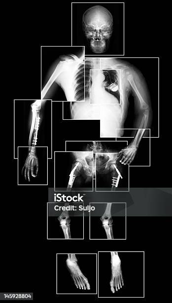 Raiosx Do Corpo Humano - Fotografias de stock e mais imagens de Autópsia - Autópsia, Imagem de raios X, Raio X