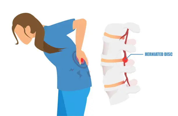 Vector illustration of Vector of a woman with a low back pain and sciatica from a herniated disc.