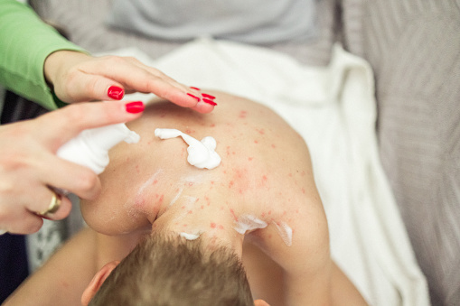 High angle view of an unrecognizable mother put an lotion on her son's skin,to reduce the itching of chicken pox