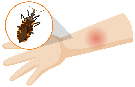 Human arm swollen from kissing bug bite illustration