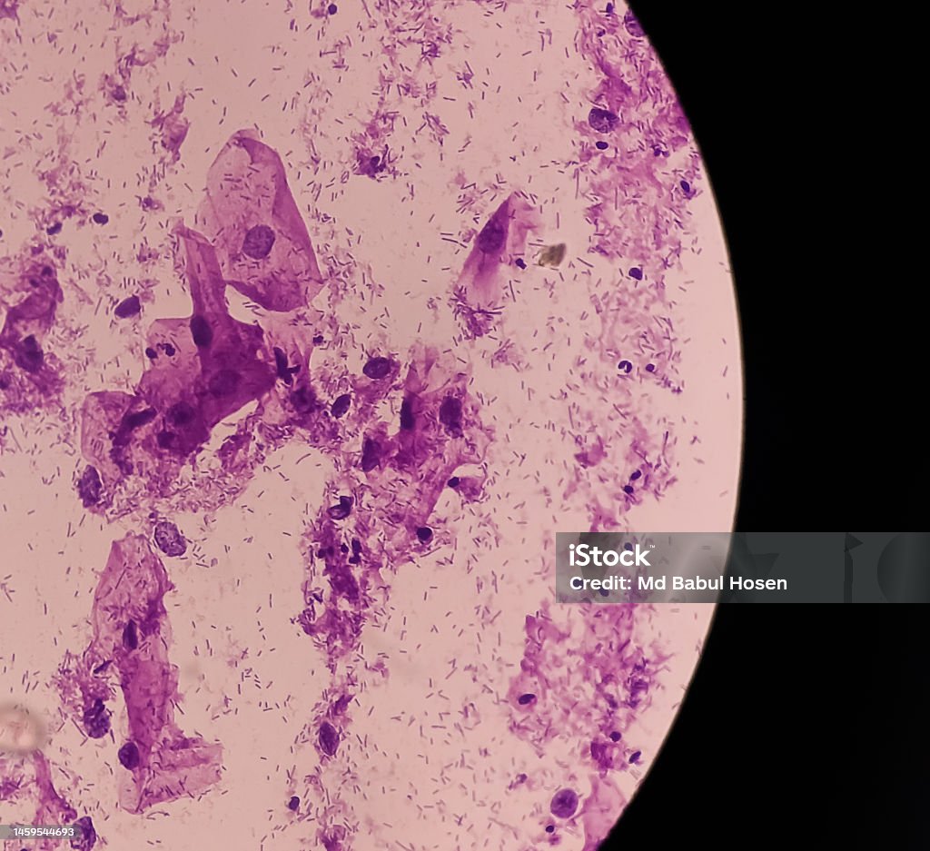 Paps Smear Microscopic View Of Pap Smear Showing Severe Inflammatory Paps Smear Microscopic View Of Pap Smear Showing Severe Inflammatory