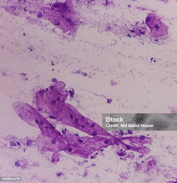 Paps Smear Microscopic View Of Pap Smear Showing Severe Inflammatory Paps Smear Microscopic View Of Pap Smear Showing Severe Inflammatory