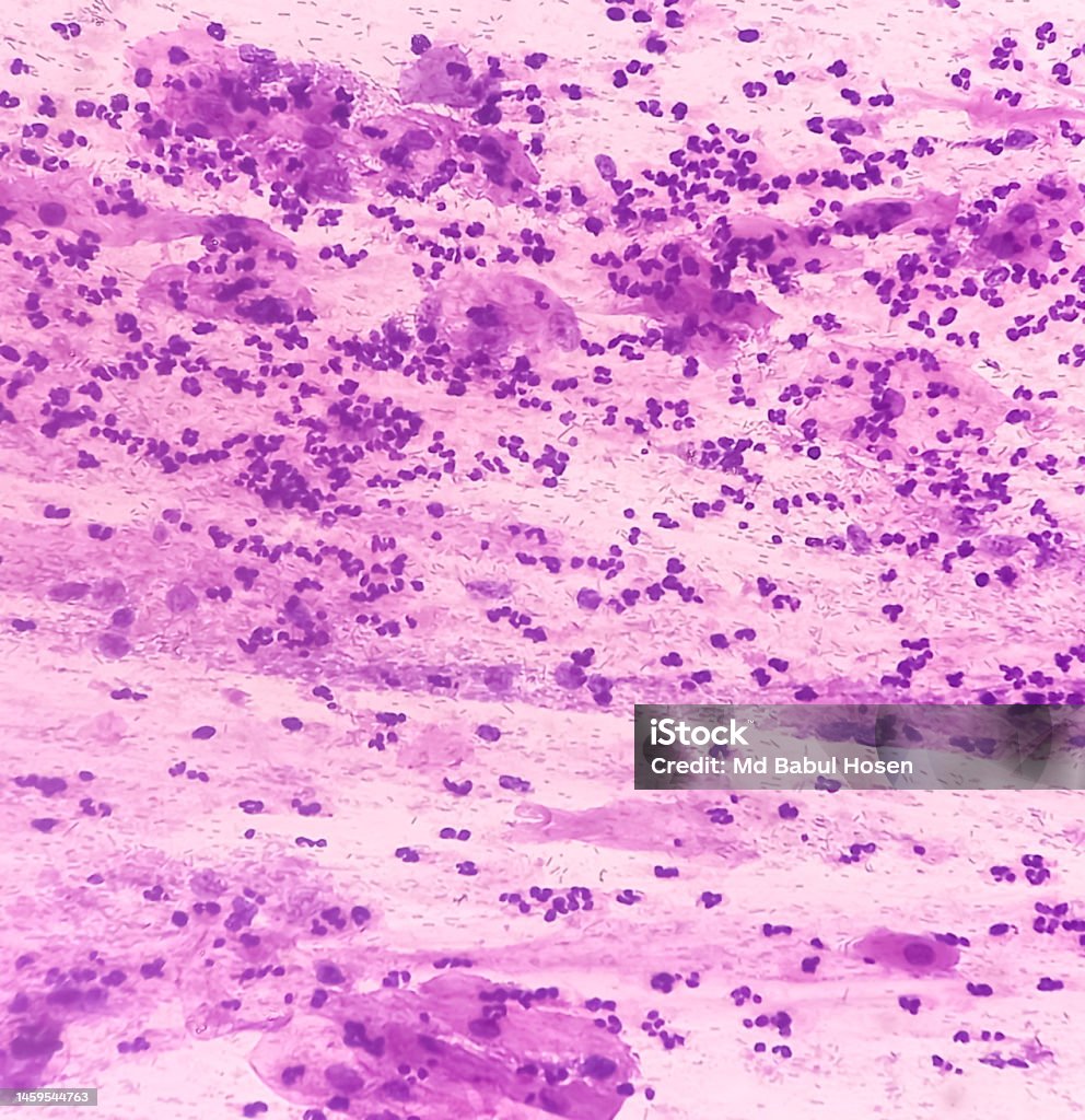Paps Smear Microscopic View Of Pap Smear Showing Severe Inflammatory Paps Smear Microscopic View Of Pap Smear Showing Severe Inflammatory
