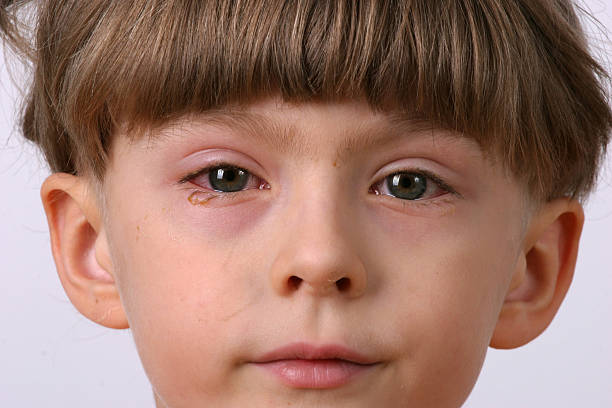 ill allergic eyes - conjunctivitis ill allergic eyes - conjunctivitis demobilization photos stock pictures, royalty-free photos & images