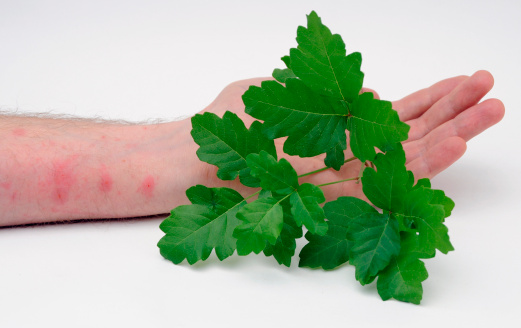 Poison Oak leaves held by someone with a Poison Oak skin rash.