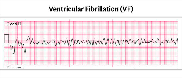 ekg-kammerflimmern (vf) - 8-sekunden-elektrokardiographie-papier - herzkammer stock-grafiken, -clipart, -cartoons und -symbole