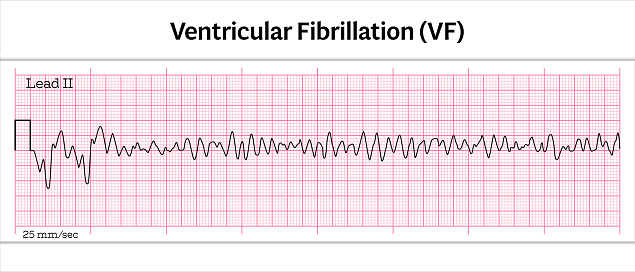 ECG Ventricular Fibrillation (VF) - 8 Second Electrocardiography (ECG) Paper - Vector Medical Illustration