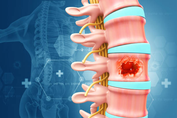 Spine cancer or spinal tumor disease. 3d illustration Spine cancer or spinal tumor disease. 3d illustration Spinal Stenosis stock pictures, royalty-free photos & images