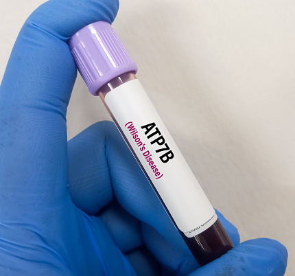 Valid Atp Sample Blood Sample For Atp7b Test Rare Or Orphan Disease Molecular Genetics ...