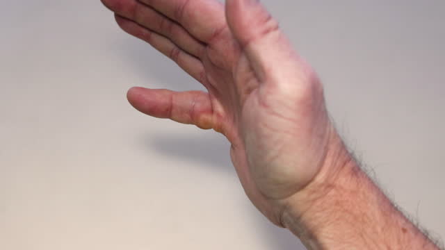 Dupuytren's contracture of little finger on man's palm