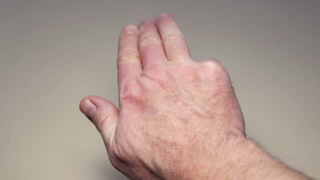 Dupuytren's contracture of little finger on man's palm