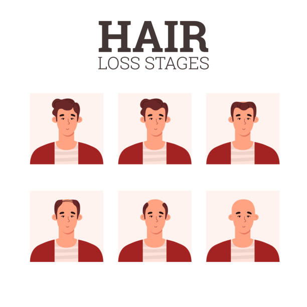 ilustrações, clipart, desenhos animados e ícones de estágios de perda de cabelo, infográficos de problemas de alopecia - ilustração vetorial plana no fundo branco. - alopecia homem