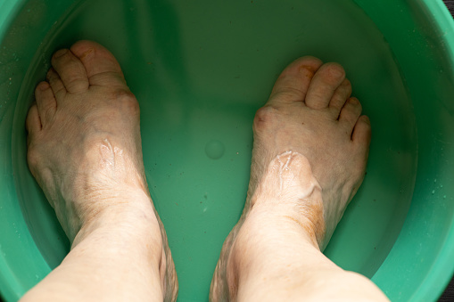 Swelling from edema from excess fluid trapped in tissues on a caucasian women's feet and ankles.