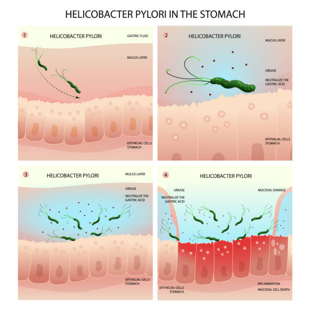 ilustraciones, imágenes clip art, dibujos animados e iconos de stock de proceso de infección por helicobacter pylori en el estómago humano con desarrollo de gastritis - pylori