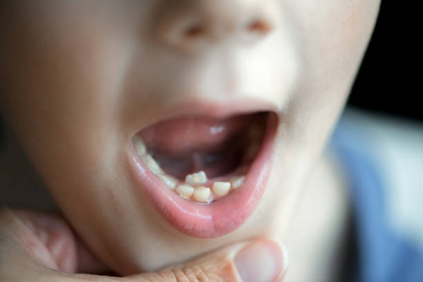 Shark teeth dental problem - new tooth grew behind primary teeth stock photo
