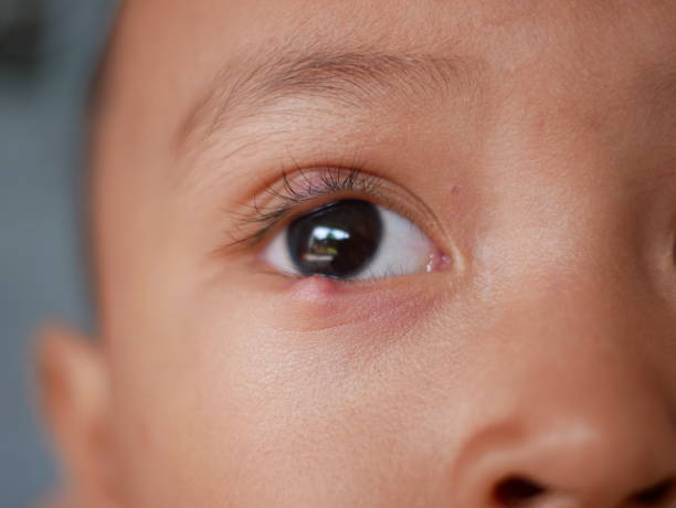 Closeup of infected eye with painful bump on lower eyelid. eye disease Closeup of infected eye with painful bump on lower eyelid. eye disease staphylococcal enterotoxicosis stock pictures, royalty-free photos & images