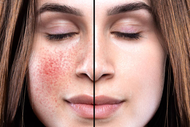 Close-up portrait showing the before and after results of rosacea on the cheeks of a young girl A close-up portrait showing the before and after results of rosacea on the cheeks of a young girl rosy cheeks stock pictures, royalty-free photos & images