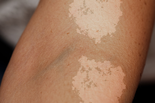 A closeup view on the arm of a person suffering from tinea versicolor, a fungal infection of malassezia globosa, causing patches of skin discoloration