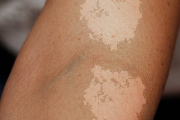 a closeup view on the arm of a person suffering from tinea versicolor - frieiras imagens e fotografias de stock