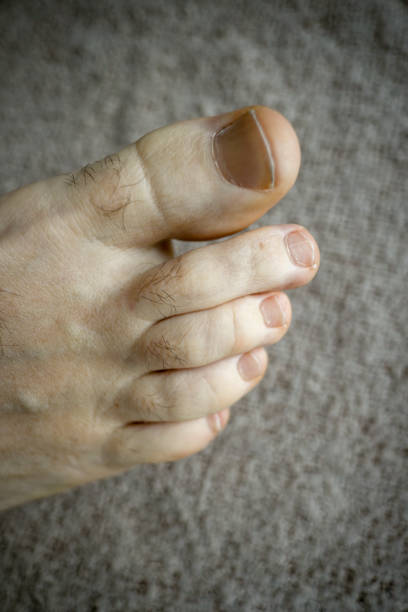istock Human body, foot, toes, white, old person 1461102034