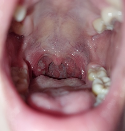 Tonsillitis push or abcess infection on throat  induce pain and fever