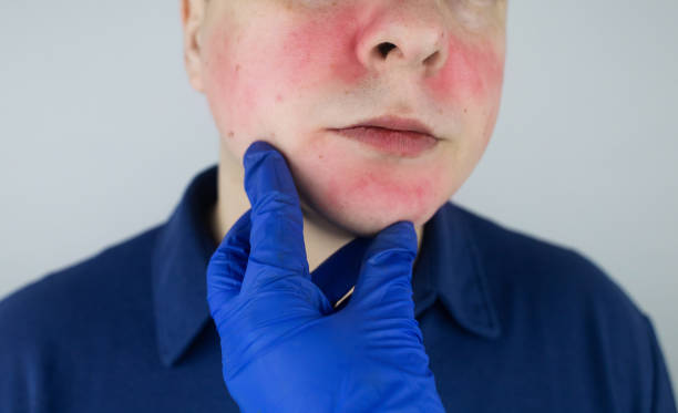 Rosacea face. The man suffers from redness on her cheeks. Couperose of the skin. Redness and capillary mesh are visible on the face. Treatment and removal. Vascular surgery and dermatology The man suffers from redness on her cheeks. Couperose of the skin. Redness and capillary mesh are visible on the face. Treatment and removal. Vascular surgery and dermatology. Rosacea face. cheek cell stock pictures, royalty-free photos & images