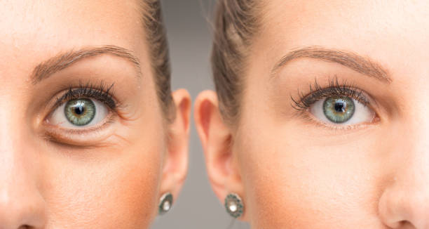 kobiece oko ze zmarszczkami i kurzymi łapkami przed i po zabiegu kosmetycznym - puffed zdjęcia i obrazy z banku zdjęć