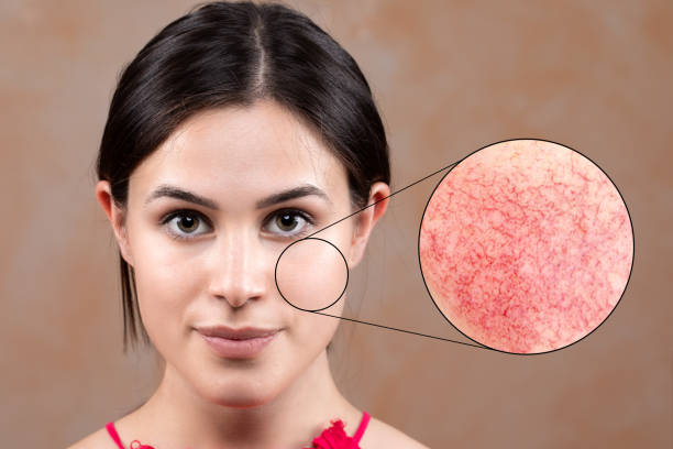 Young woman with rosacea. A cercium shows the enlargement of a red area with couperose A close up portrait of a beautiful young caucasian woman, a magnified circle shows macro detail of rosacea in the cheek, red capillaries of couperose rosy cheeks stock pictures, royalty-free photos & images