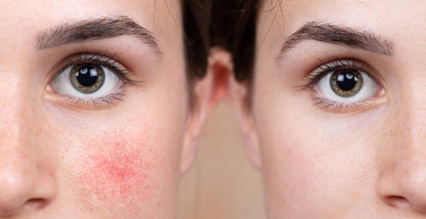 Half face of girl showing before and after of rosacea cure (couperose) A young Caucasian girl shows the before and after results of intensive light surgery to remove the symptoms of rosacea. Noticeable reduction in cheens skin cheek stock pictures, royalty-free photos & images