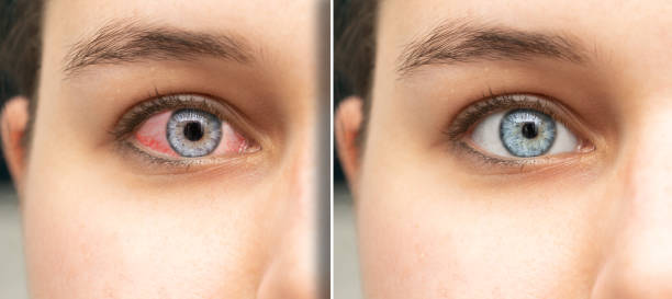istock woman's red eye before and after using emollient eye drops 1461286480