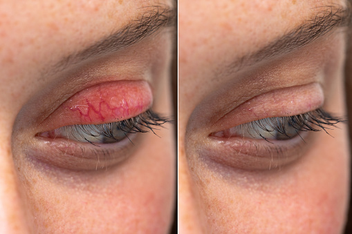 Comparación de la blefaritis del párpado superior del ojo humano antes y después de la comparación de blefaritis lado a lado photo